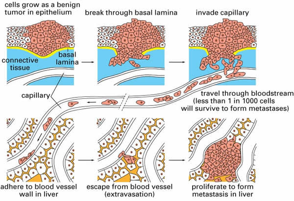 Scheme of cancer progression