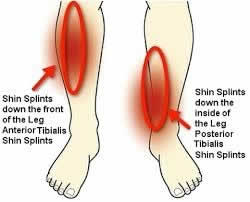 Different areas of the leg where people commonly experience shin splints