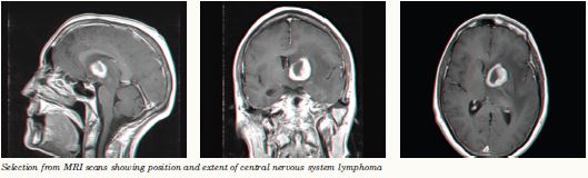 MRI scan of lymphoma