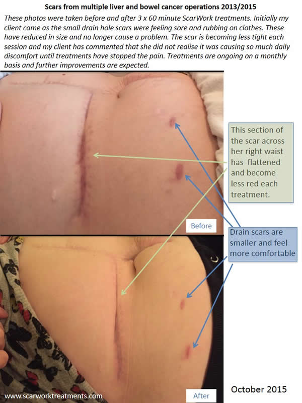 before and after bowel cancer scars