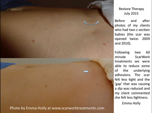 before and after c-section scar