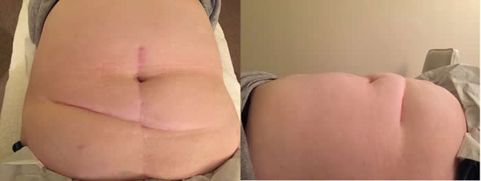 Crohns Scar After 1 and 2 Composite