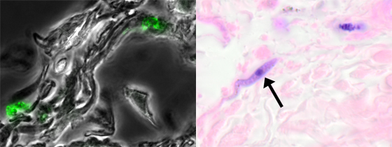 Stopping Breast Cancer Metastasis in Its Tracks + Nearly One-Third of Unnecessary Endoscopies could be Avoided with Faeces Blood Test + Sleeping Sickness: Parasites Found Hiding in the Skin