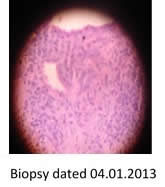 Biopsy 04.01.2013