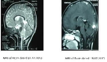 Case 2 MRI of Brain