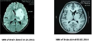 MRI of Brain