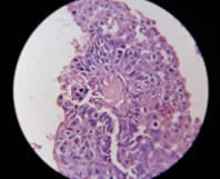 Stereotactic Biopsy dated  20.04.2013