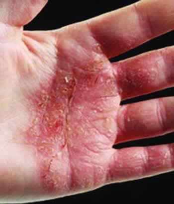 What You Should Know About Eczema