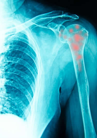 Weightlifting Injury Prevention 4 Shoulder Impingement