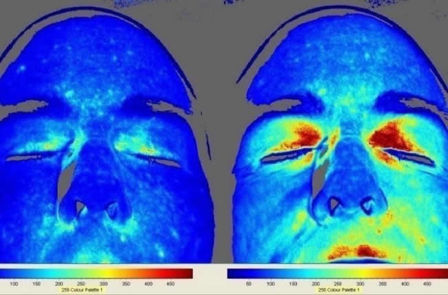 Speckle Contrast Laser Imager Improved Facial