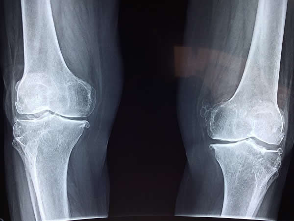 knee arthritis