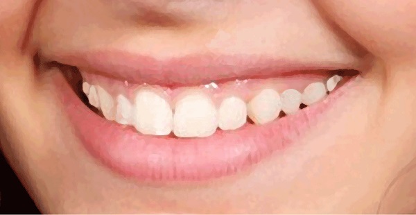 Pai 247 8 Benefits of Having Straight Teeth