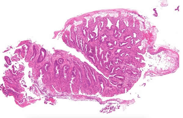 Chaga and GI Tract