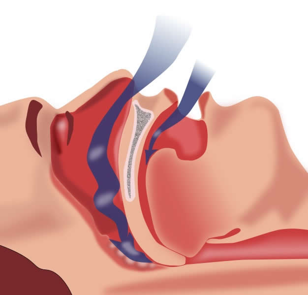 Obstruction_ventilation_apnée_sommeil