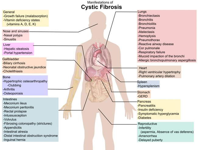 Manifestations of Cystic Fibrosis