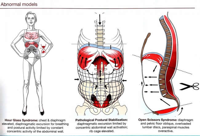 Abnormal-Models-Exercises-that-cause-back-pain