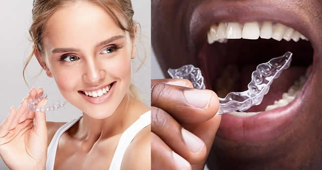 Invisalign and 3M Clarity Aligners