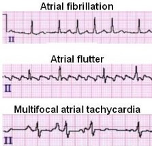 Atrialfibrillation