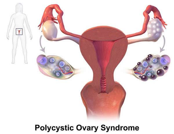 A Medical Illustration Depicting PCOS