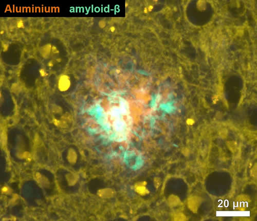 Book Figure 7 Brain tissue with Alzheimers