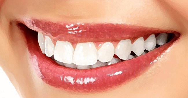 Dental Veneers