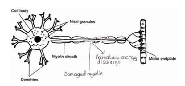 Diagram of nerve transmission disruption where myelin is damaged