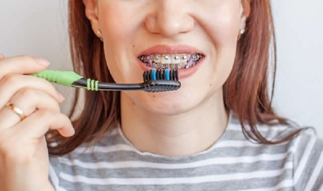 7 Tips on Properly Brushing and Flossing With Braces