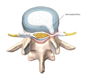 Herniated Disc