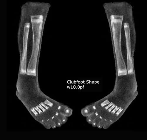 Clubfoot shape