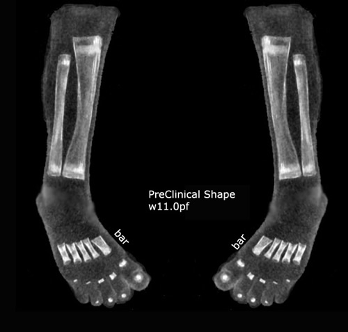 Preclinical Clubfoot shape
