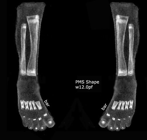 Primus Metatarsus Supinatus (Rothbart) shape