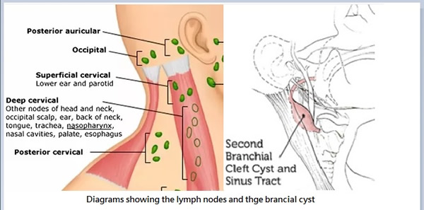 Lymph Nodes and the Branchial Cyst