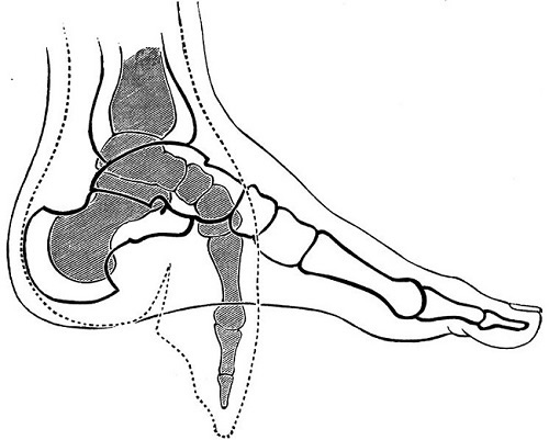 Natural_Foot_and_a_Chinese_Deformed_Foot