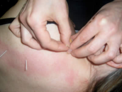 Acupuncture Needling Shoulder Compressed