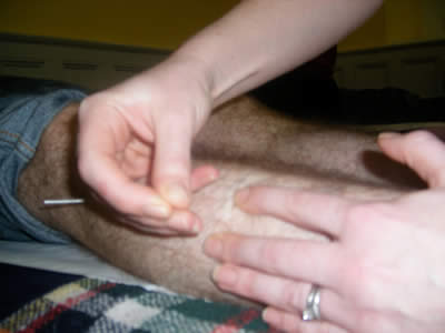 Acupuncture Needling leg Compressed
