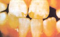 Moderately severe dental fluorosis in an eight-year-old boy showing discoloration