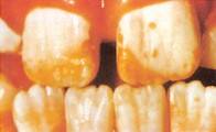 Moderately severe dental fluorosis in a nine-year-old boy showing discoloration and pitting.