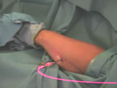 Hollow fibres were placed into the arm down which the laser was directed.