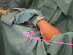 Hollow fibres were placed into the arm down which the laser was directed.