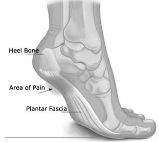 Foot image with heel and area of pain