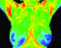 Thermal Breast Screening at The Homeopathic Clinic
