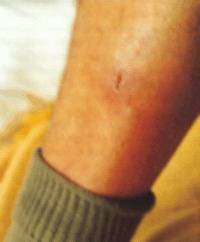 Photo 4 - Injury after treatment