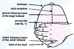 Treatment Position VI. The right hand is used here on the right half of the skull. The curing effect is much weaker when the left palm is applied. Use the whole length of the middle finger to find the longitudinal groove remaining in the forhead section following the fusion of the large fontanel. The middle finger should be left in the groove. The palm heel should rest just above the horizontal line linking the eyebrow with the base of the ear. The thumb should be spread and the remaining fingers kept together. Position VI is used to treat insomnia.