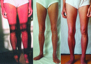 legs before, during and after treatment