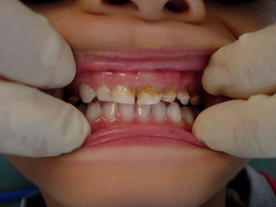 Figure 1. This shows a three year old child with rampant tooth decay. Note the asymmetric distribution of the tooth decay affecting the child's upper left teeth.