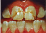 Flourosis is the brown mottling of teeth due to Flouride