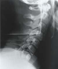 X-ray taken in A & E on 30th June 1998 Ã¢â‚¬â€œ it is difficult to see the injury due to the button which covers the vertebrae; however, when looked at closely it shows the misalignment of the 5th vertebra of the spinal column