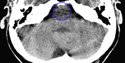 Robert Waghmare's Brain CT of the Brain Stem, showing markings in the area corresponding to the kidney collecting tubules (taken in 2006)