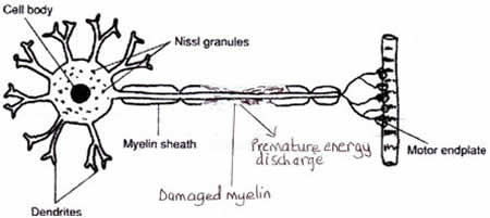 Diagram of nerve transmission disruption where myelin is damaged