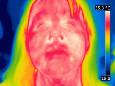 Thermal Image Patient A
